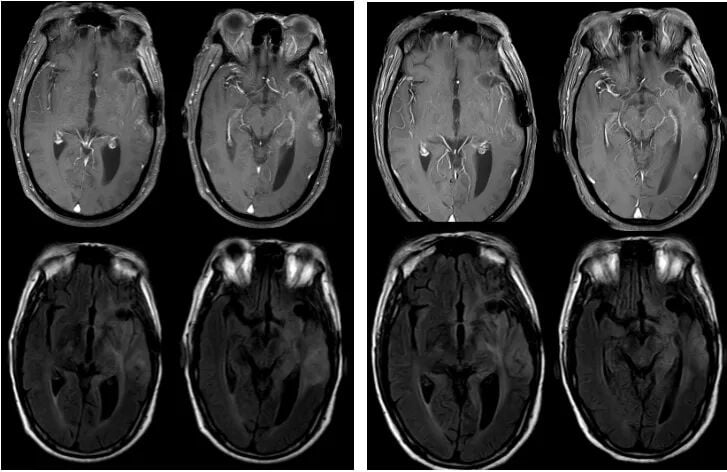 复发胶质母细胞瘤新选择:替尼泊苷联合贝伐珠单抗治疗成功病例解读 6 图片