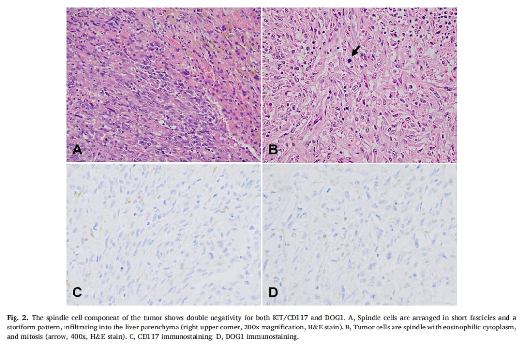 伊马替尼治疗后GIST肝转移灶标志物消失?KIT基因检测成诊断关键 2 图片