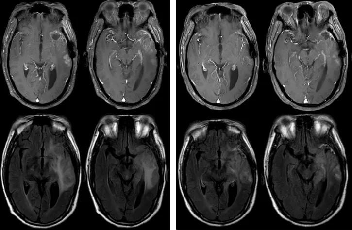 复发胶质母细胞瘤新选择:替尼泊苷联合贝伐珠单抗治疗成功病例解读 5 图片