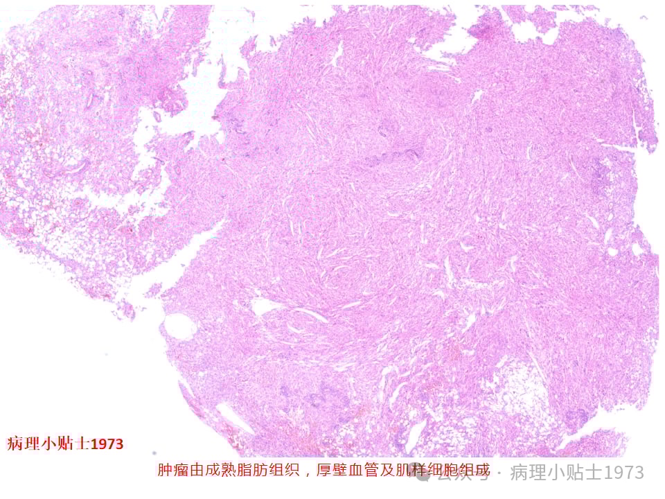 肾脏血管平滑肌脂肪瘤(AML)是什么?一文详解其症状、诊断与TSC基因突变 1 图片
