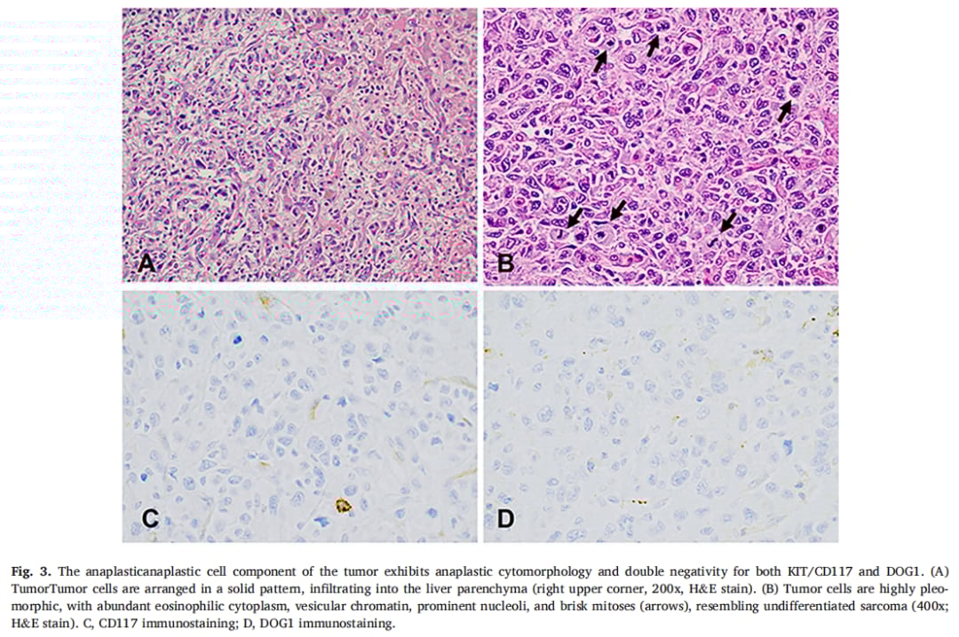 伊马替尼治疗后GIST肝转移灶标志物消失?KIT基因检测成诊断关键 3 图片