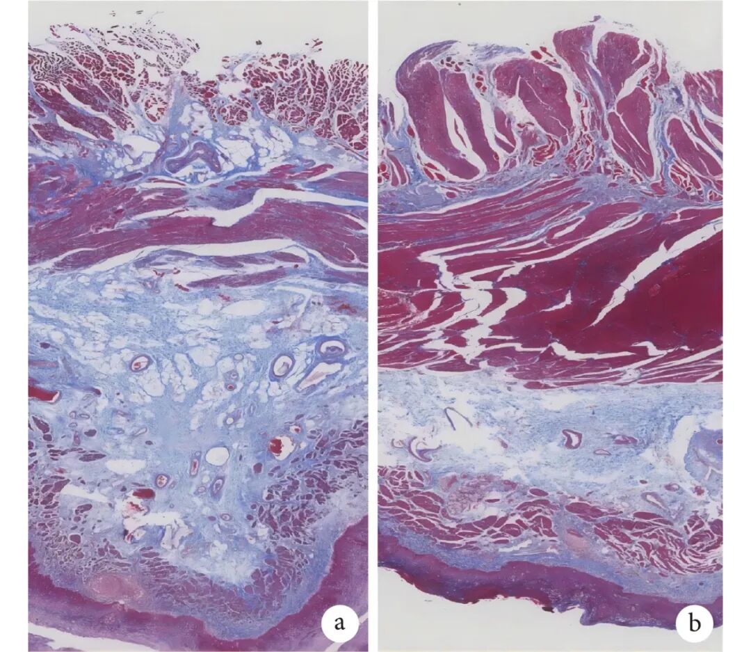 食管鳞癌手术新发现:选对吻合方式,吻合口瘘风险或可降低10倍以上! 3 图片