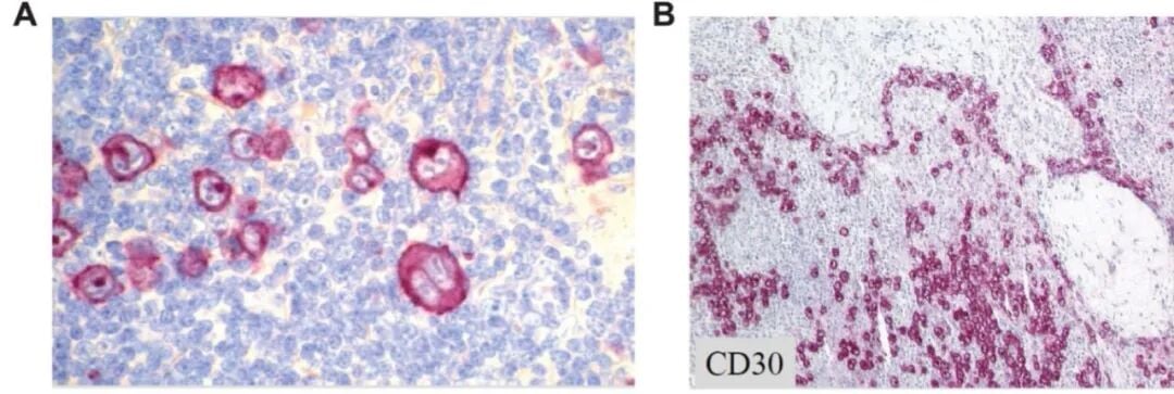 淋巴瘤治疗新靶点CD30详解:维布妥昔单抗与CAR-T疗法全解析 3 3.jpg