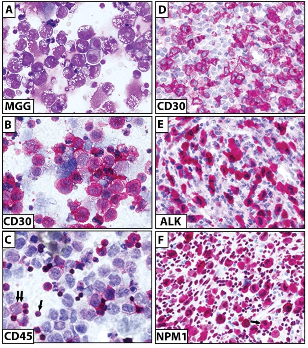 淋巴瘤治疗新靶点CD30详解:维布妥昔单抗与CAR-T疗法全解析 5 6.jpg