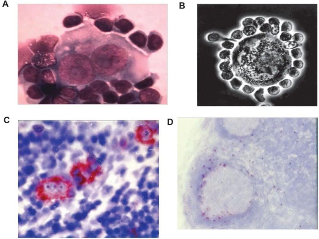 淋巴瘤治疗新靶点CD30详解:维布妥昔单抗与CAR-T疗法全解析 2 2.jpg