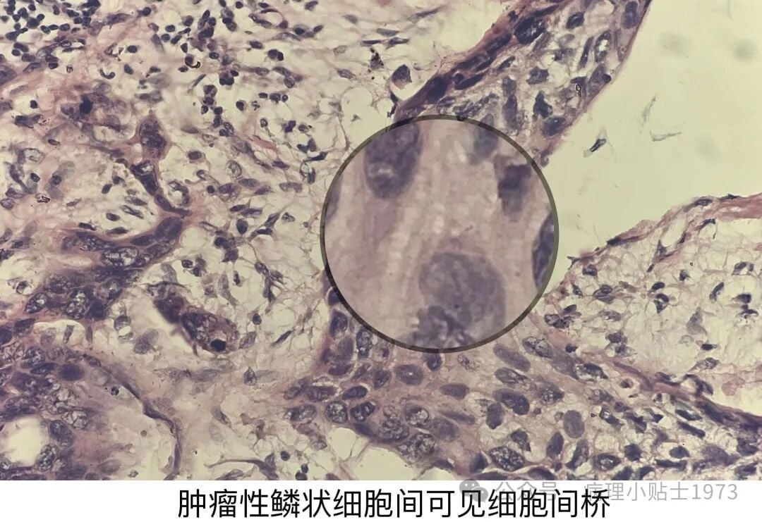 54岁男性右肺肿块确诊肺鳞癌:深入了解角化型肺鳞癌的诊断与治疗 6 图片