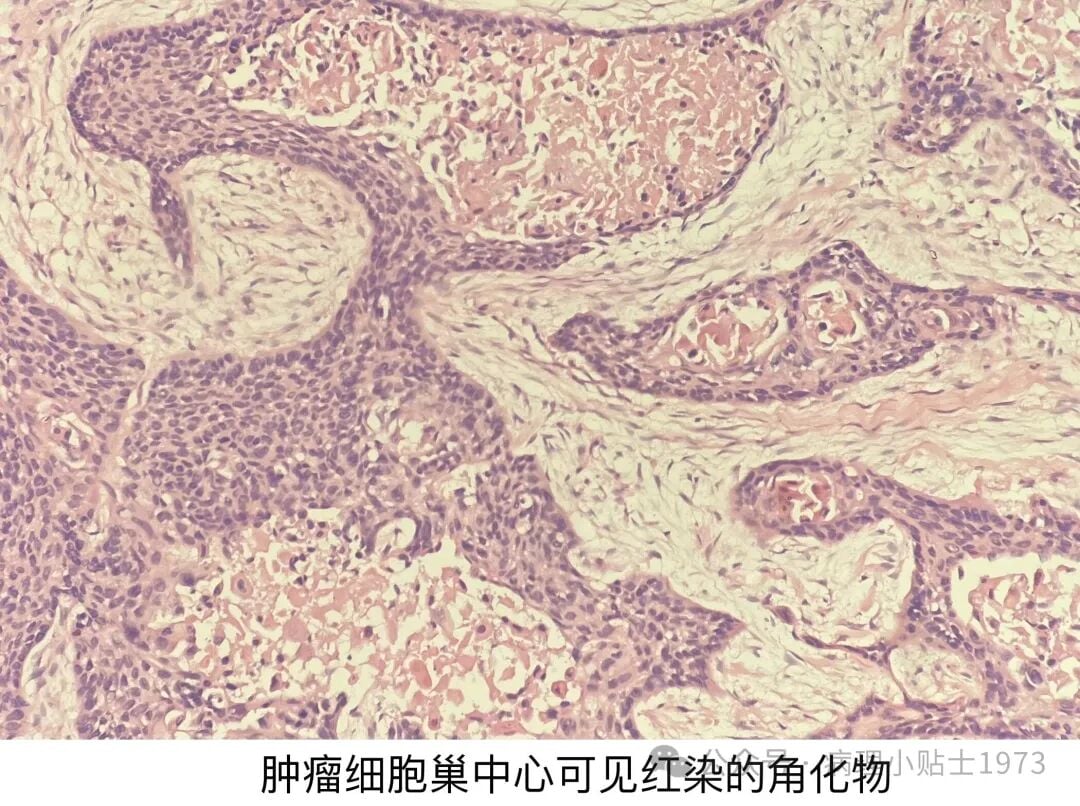 54岁男性右肺肿块确诊肺鳞癌:深入了解角化型肺鳞癌的诊断与治疗 3 图片