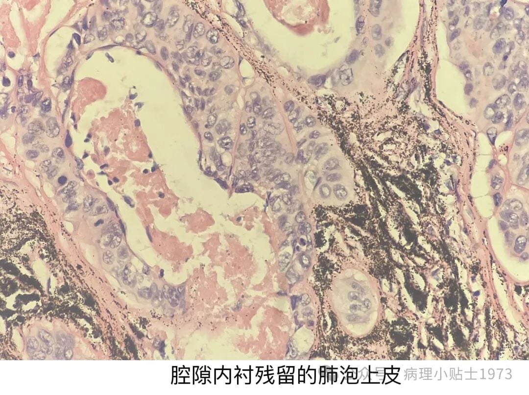 54岁男性右肺肿块确诊肺鳞癌:深入了解角化型肺鳞癌的诊断与治疗 9 图片