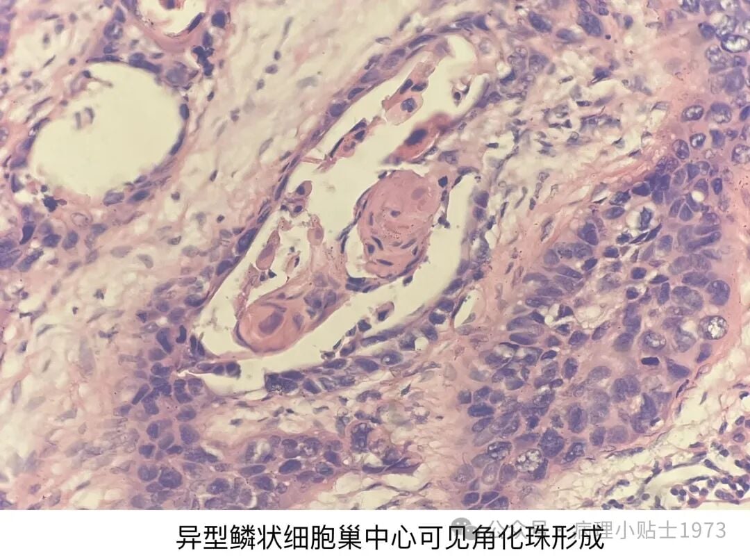 54岁男性右肺肿块确诊肺鳞癌:深入了解角化型肺鳞癌的诊断与治疗 5 图片