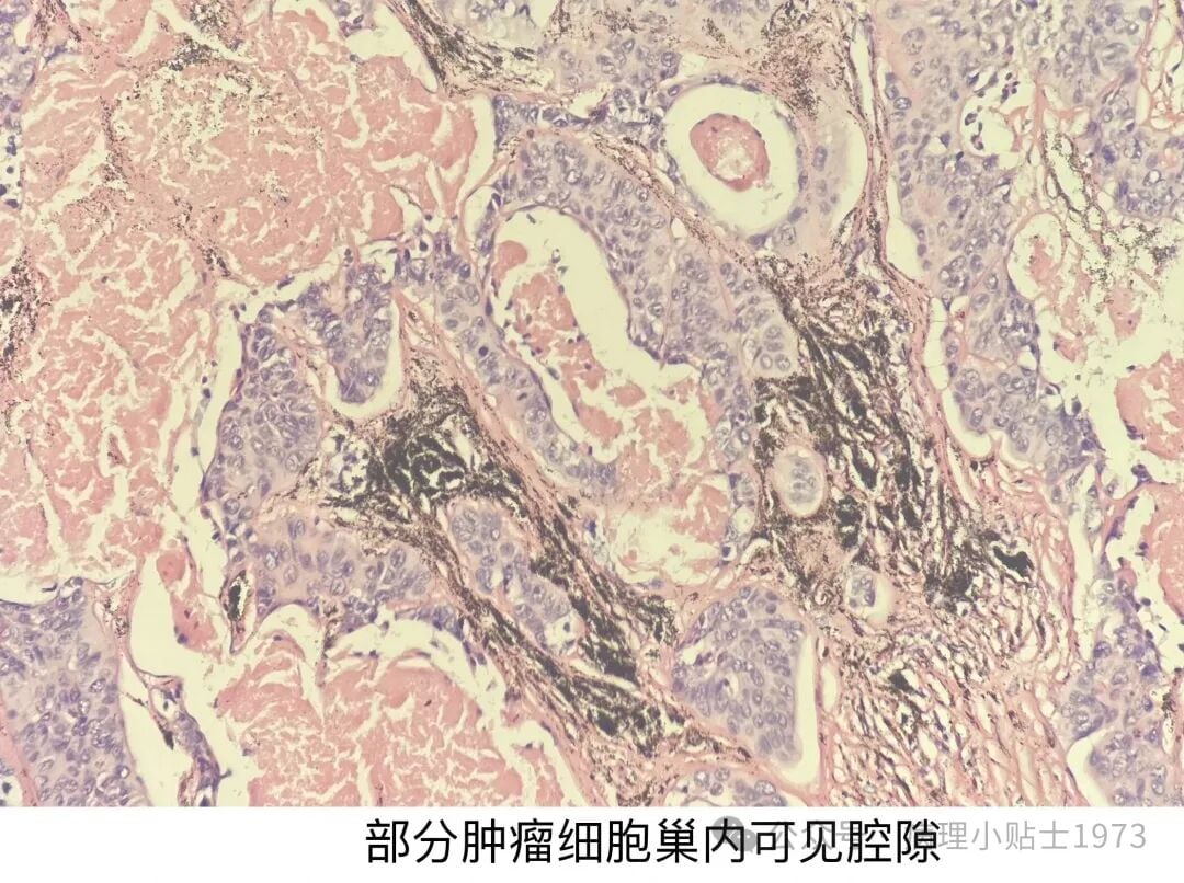 54岁男性右肺肿块确诊肺鳞癌:深入了解角化型肺鳞癌的诊断与治疗 8 图片
