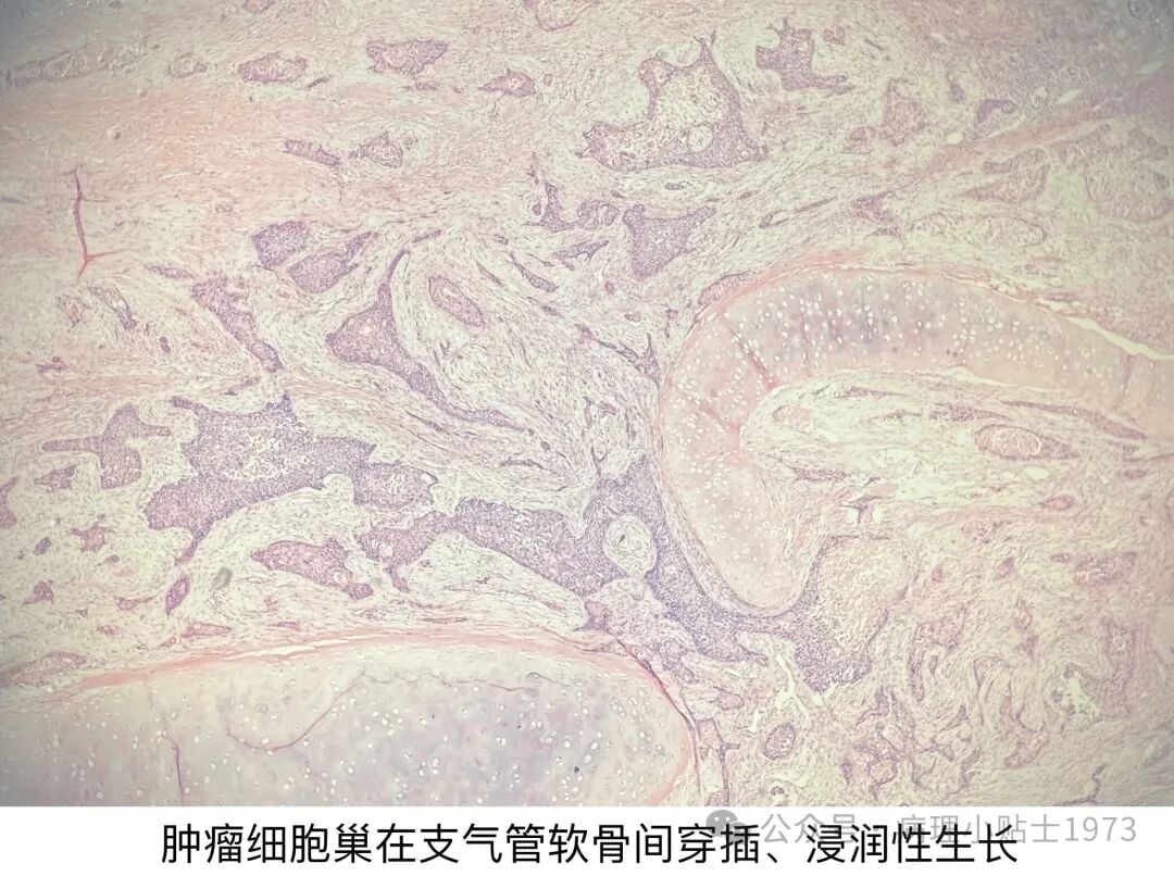 54岁男性右肺肿块确诊肺鳞癌:深入了解角化型肺鳞癌的诊断与治疗 1 图片