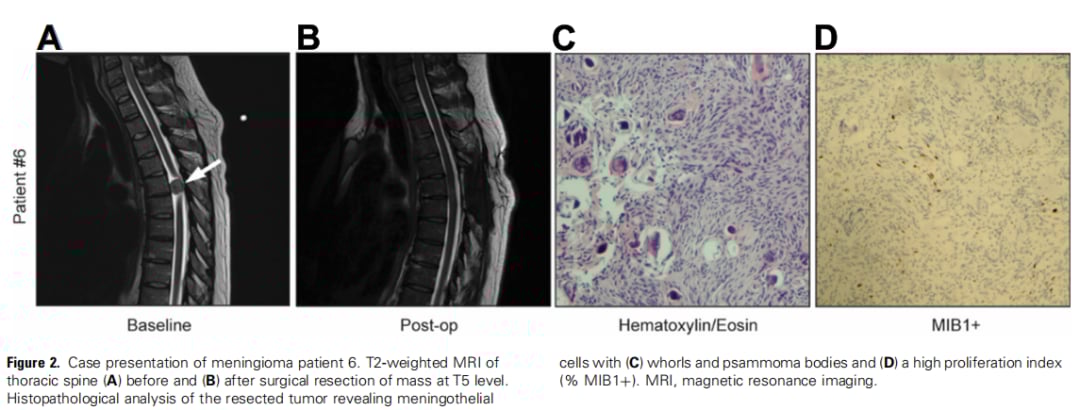 脊髓脑膜瘤分子特征与靶向治疗:NF2、AKT1、SMARCB1突变解析及药物选择 5 图片