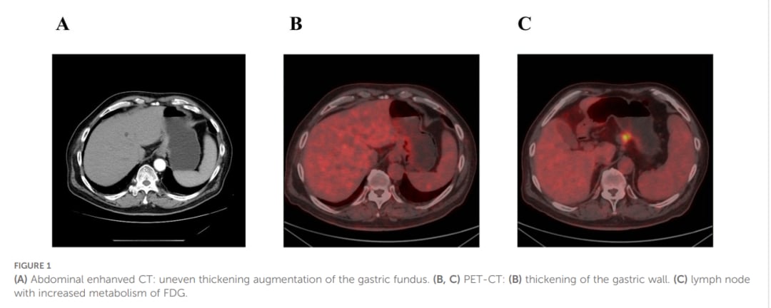 罕见三重癌症共存:华氏巨球蛋白血症、HER2胃癌与GIST的诊断与泽布替尼应用解析 1 图片