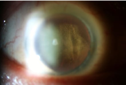 眼内淋巴瘤:被称为“伪装者”的眼底杀手,如何通过多模态影像精准识别与治疗? 2 image.png