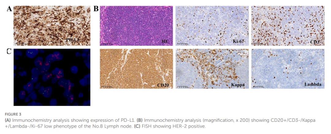 罕见三重癌症共存:华氏巨球蛋白血症、HER2胃癌与GIST的诊断与泽布替尼应用解析 3 图片