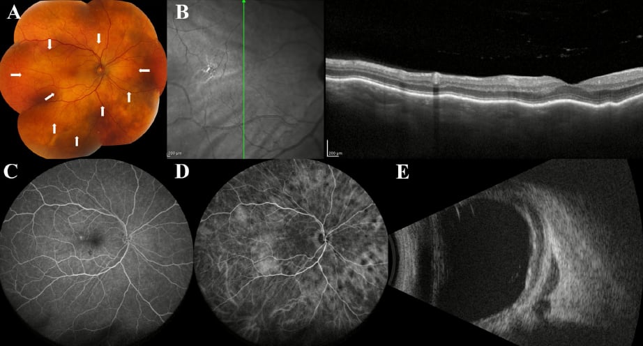 眼内淋巴瘤:被称为“伪装者”的眼底杀手,如何通过多模态影像精准识别与治疗? 3 image.png