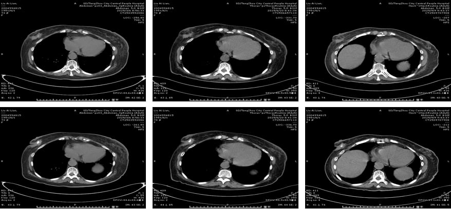 HER2阳性乳腺癌多线治疗:8年抗癌路,德曲妥珠单抗等新药如何延长生命? 4 image.png