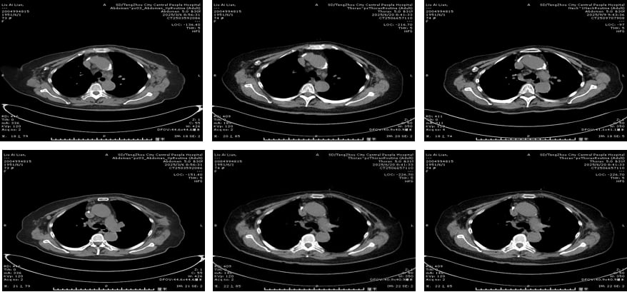 HER2阳性乳腺癌多线治疗:8年抗癌路,德曲妥珠单抗等新药如何延长生命? 3 image.png