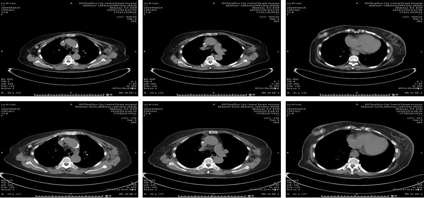 HER2阳性乳腺癌多线治疗:8年抗癌路,德曲妥珠单抗等新药如何延长生命? 2 image.png