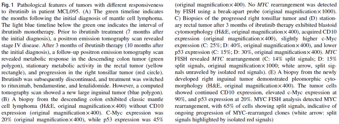 伊布替尼治疗套细胞淋巴瘤耐药新突破:MYC重排机制与应对策略 5 图片