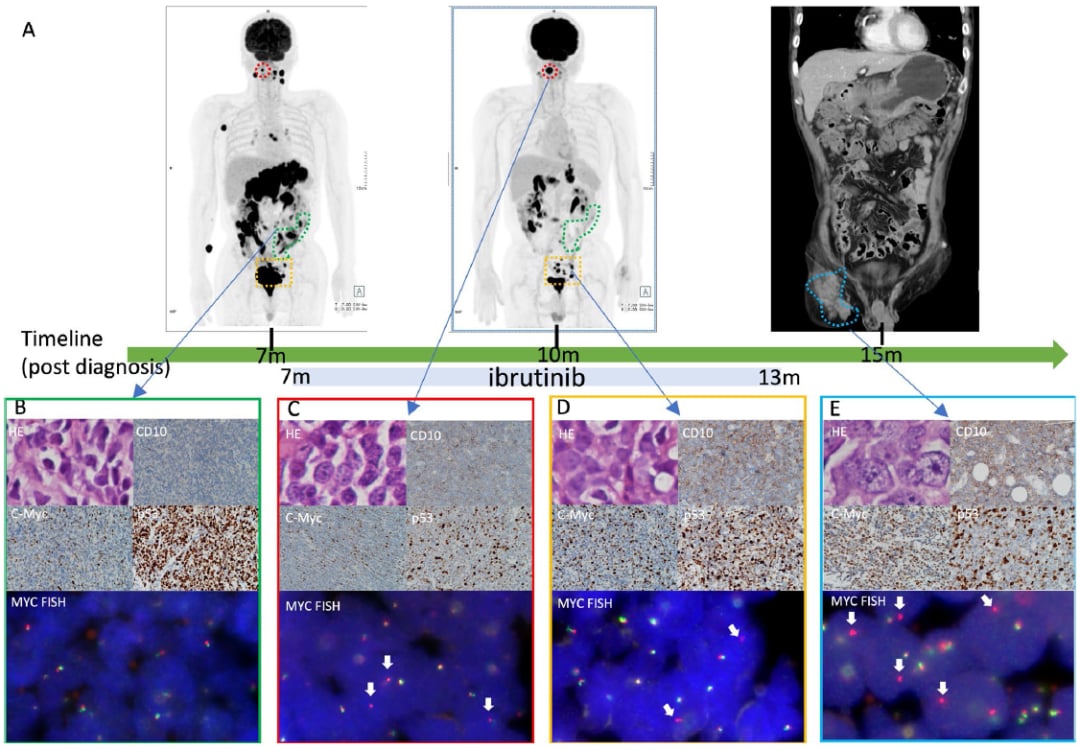 伊布替尼治疗套细胞淋巴瘤耐药新突破:MYC重排机制与应对策略 4 图片