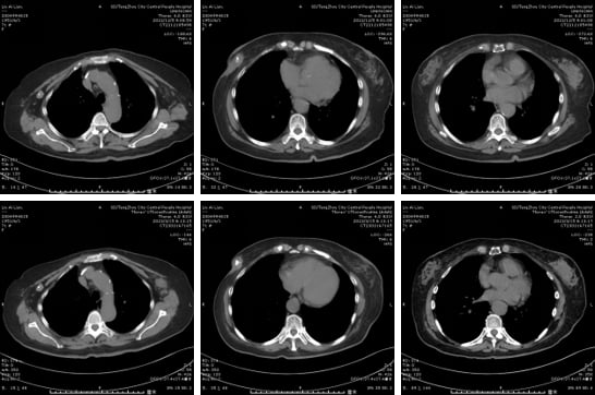 HER2阳性乳腺癌多线治疗:8年抗癌路,德曲妥珠单抗等新药如何延长生命? 1 image.png