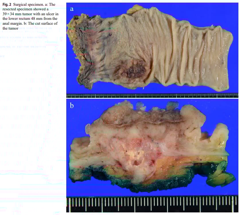直肠腺癌遇上卵黄囊瘤:KRAS G12S突变患者的罕见挑战与精准诊疗策略 3 图片
