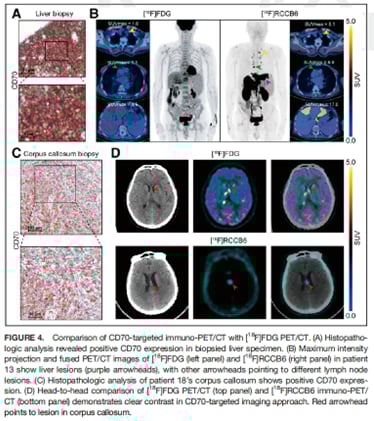 淋巴瘤靶向治疗新工具:CD70免疫PET/CT精准评估表达异质性与疗效监测 4 image.png