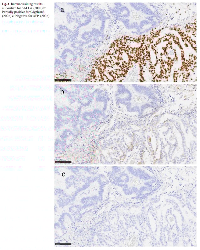 直肠腺癌遇上卵黄囊瘤:KRAS G12S突变患者的罕见挑战与精准诊疗策略 5 图片