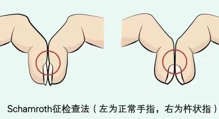 肺癌早期预警:指甲异常或是救命信号?专家详解手指杵状膨大与自测方法 1 图片