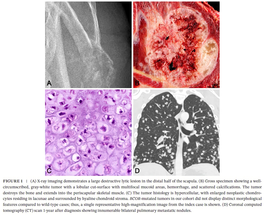 软骨肉瘤新发现:BCOR突变预示疾病侵袭性?深度解读与治疗展望 1 图片
