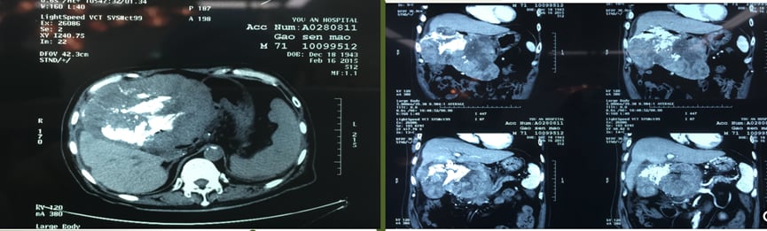 肝癌切除 vs 肝移植:肝癌患者的终极治疗抉择与生存指南 2 肝癌IVb段局部肿瘤切除手术示意图及胃、横结肠切除案例