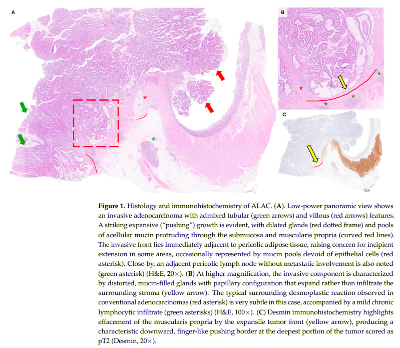 结肠腺瘤样腺癌(ALAC)深度解读:易误诊却预后良好?dMMR检测助您精准辨识! 3 结肠腺瘤样腺癌(ALAC)的组织学和免疫组织化学图片