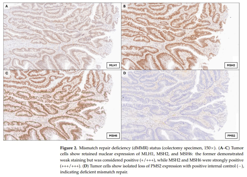 结肠腺瘤样腺癌(ALAC)深度解读:易误诊却预后良好?dMMR检测助您精准辨识! 4 结肠腺瘤样腺癌(ALAC)患者错配修复缺陷(dMMR)状态免疫组化图片