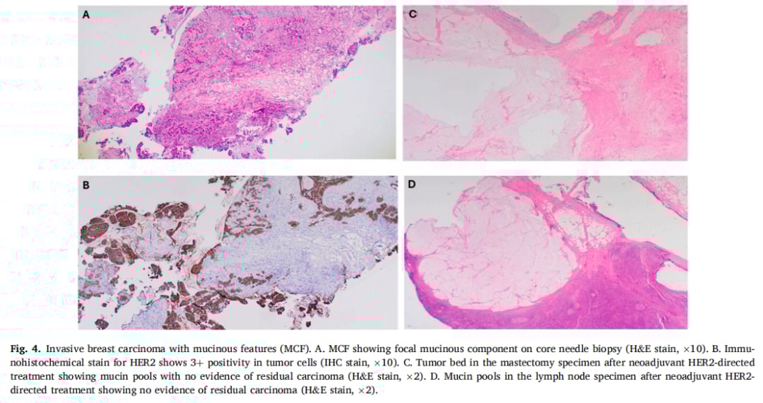 HER2阳性乳腺癌也有“特效药”禁区?深度解析罕见亚型黏液癌的耐药挑战 7 典型伴黏液特征浸润性乳腺癌MCF的病理形态