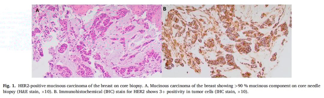 HER2阳性乳腺癌也有“特效药”禁区?深度解析罕见亚型黏液癌的耐药挑战 2 HER2阳性乳腺黏液癌穿刺活检病理切片图