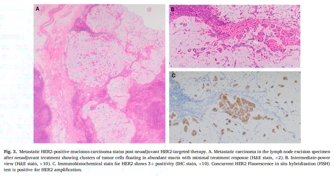 HER2阳性乳腺癌也有“特效药”禁区?深度解析罕见亚型黏液癌的耐药挑战 5 转移性HER2阳性黏液癌在治疗后的状态观察