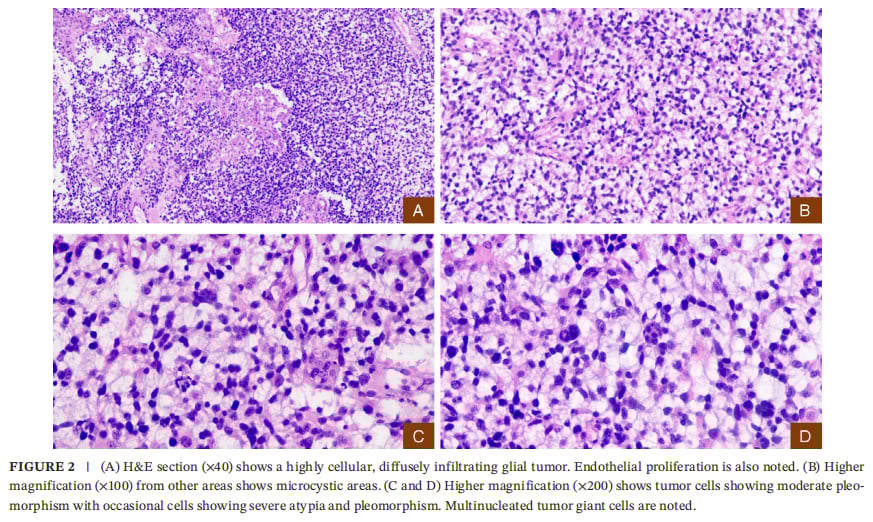 IDH1突变合并KIAA1549::BRAF融合:成人WHO4级星形细胞瘤如何做全面分子检测与用药选择 2 WHO4级星形细胞瘤病理切片:弥漫浸润、高细胞密度与微囊样改变