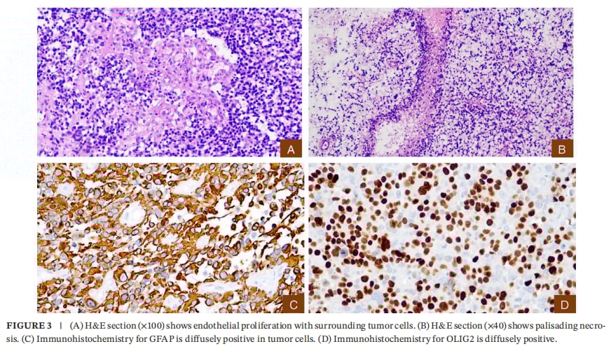 IDH1突变合并KIAA1549::BRAF融合:成人WHO4级星形细胞瘤如何做全面分子检测与用药选择 3 WHO4级弥漫性胶质瘤病理:内皮细胞增殖、栅栏样坏死及GFAP/OLIG2阳性