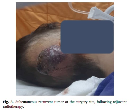 小细胞型胶质母细胞瘤怎么确诊与复发处理:儿童脑肿瘤诊断要点全解 2 小细胞型胶质母细胞瘤放疗后手术部位皮下复发肿块