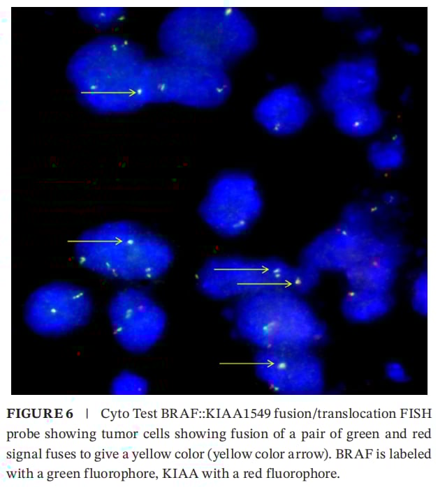 IDH1突变合并KIAA1549::BRAF融合:成人WHO4级星形细胞瘤如何做全面分子检测与用药选择 6 FISH验证KIAA1549::BRAF融合:红绿信号融合为黄色提示融合阳性