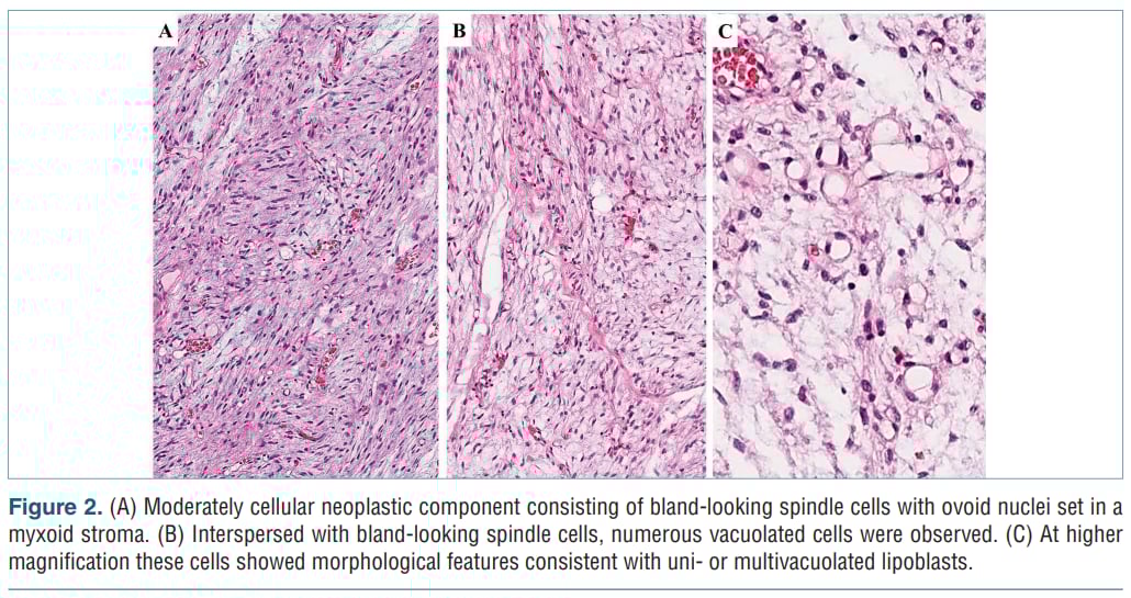 是肉瘤还是良性瘤?这种“形似”癌症的罕见肿瘤,精准诊断是关键 3 高倍镜下观察到的脂肪母细胞特征