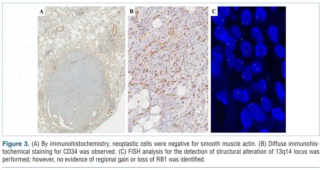 是肉瘤还是良性瘤?这种“形似”癌症的罕见肿瘤,精准诊断是关键 4 FISH检测结果显示RB1基因无结构变异