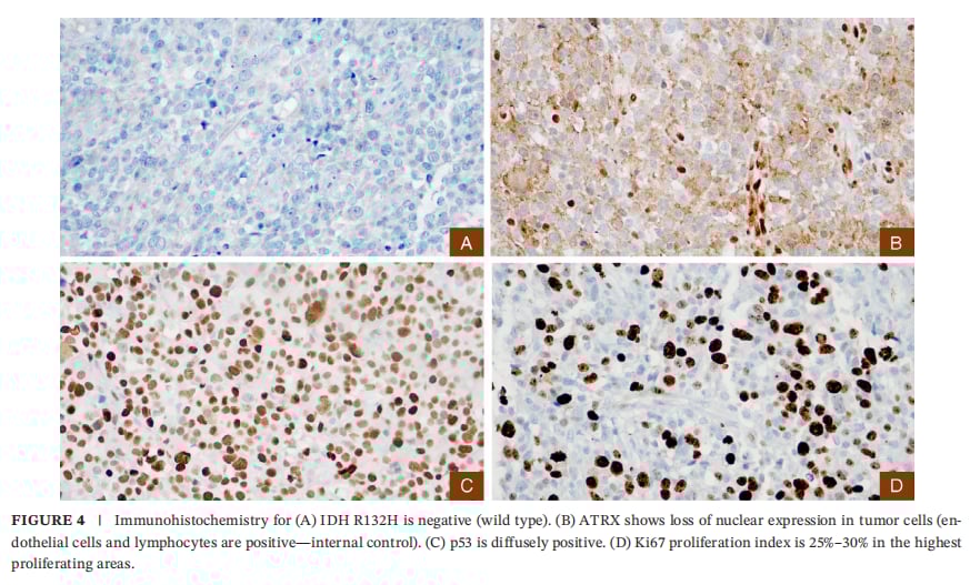 IDH1突变合并KIAA1549::BRAF融合:成人WHO4级星形细胞瘤如何做全面分子检测与用药选择 4 星形细胞瘤免疫组化:ATRX缺失、p53弥漫阳性与Ki-67高增殖指数