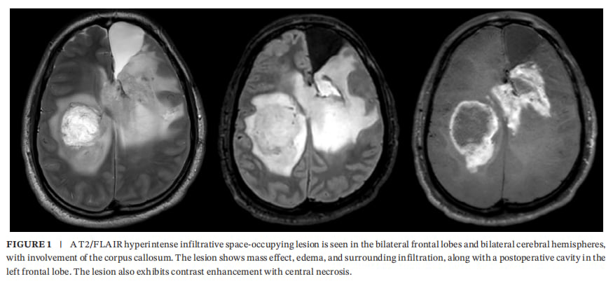 IDH1突变合并KIAA1549::BRAF融合:成人WHO4级星形细胞瘤如何做全面分子检测与用药选择 1 成人WHO4级弥漫性星形细胞瘤MRI:双侧额叶T2/FLAIR高信号浸润并累及胼胝体