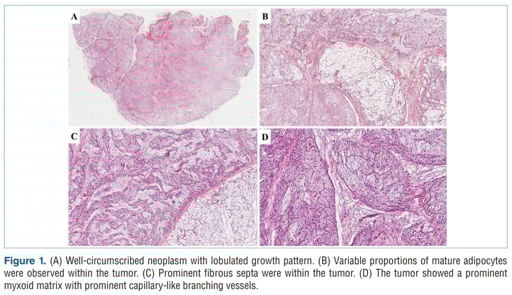 是肉瘤还是良性瘤?这种“形似”癌症的罕见肿瘤,精准诊断是关键 2 显微镜下LLT的分叶状结构与黏液样基质表现