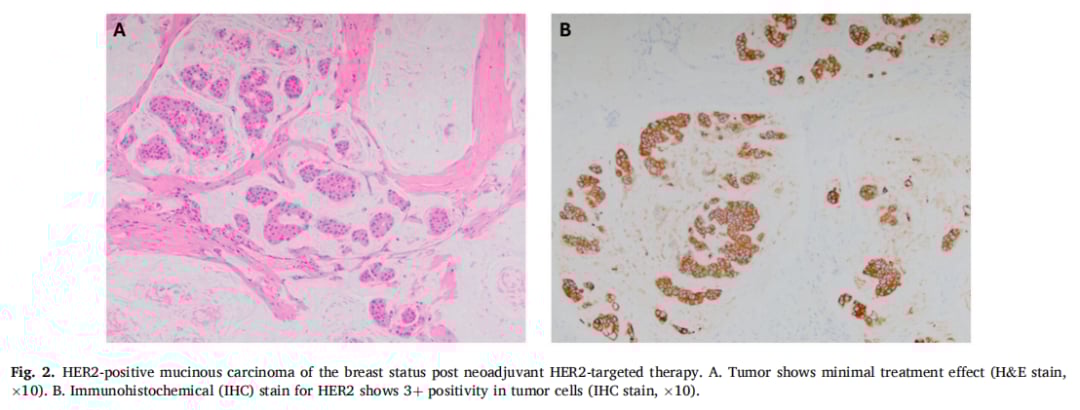 HER2阳性乳腺癌也有“特效药”禁区?深度解析罕见亚型黏液癌的耐药挑战 4 新辅助抗HER2治疗后乳腺黏液癌病灶显示耐药性