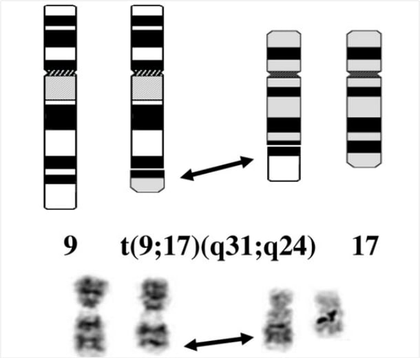 染色体易位变异导致SLC44A1-PRKCA基因融合的生物学发生机制