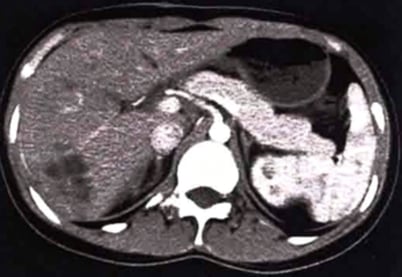 腹部增强CT显示肝脏肿瘤复发及膈肌累及二