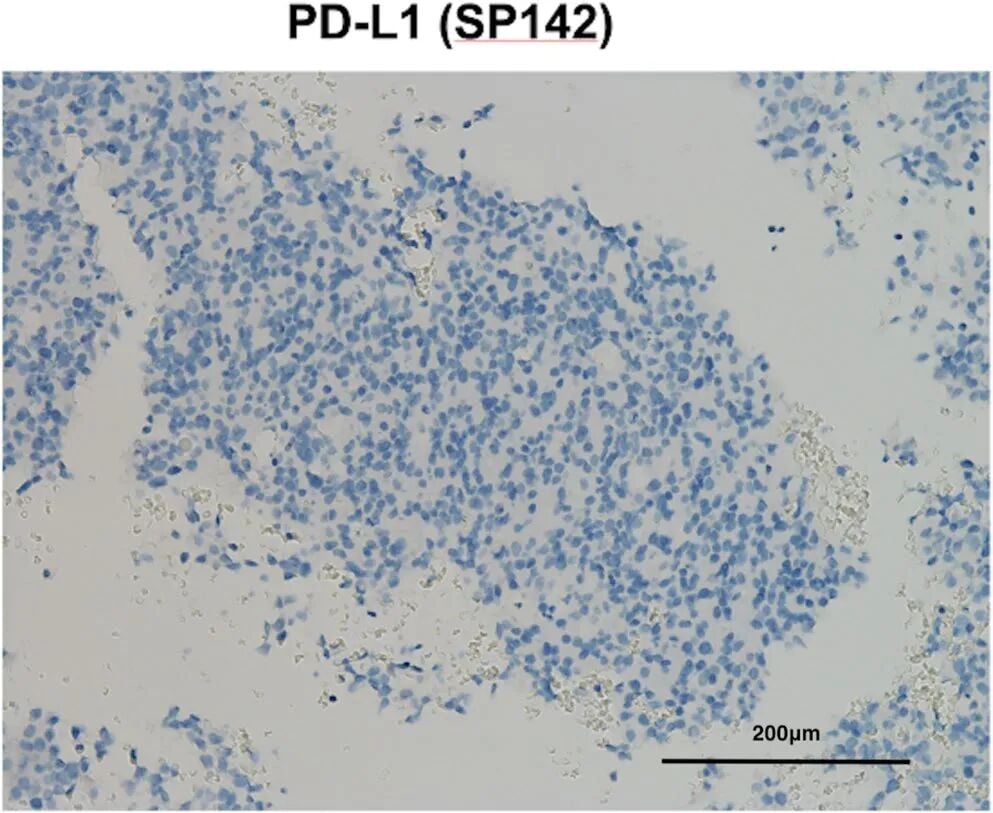 胰腺转移灶组织免疫组化SP142检测显示PD-L1呈阴性